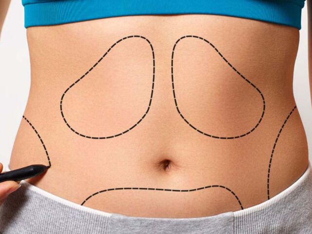 lipoliz-ile-liposuction-arasindaki-fark-nedir