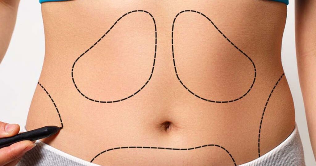 lipoliz-ile-liposuction-arasindaki-fark-nedir