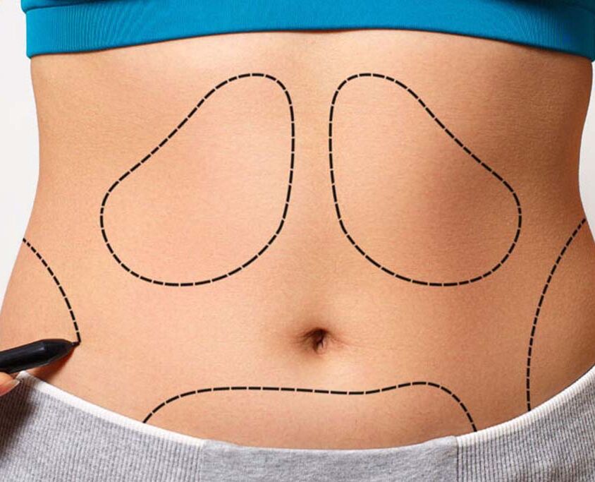 lipoliz-ile-liposuction-arasindaki-fark-nedir